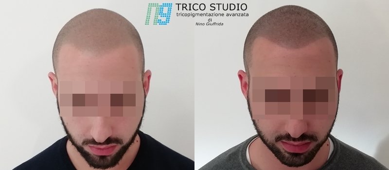Tricopoigmentazione avanzata sicilia